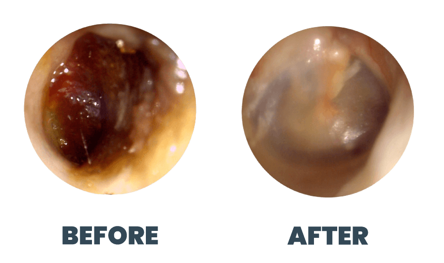 A Patients Ear's Before and After Earwax Extraction